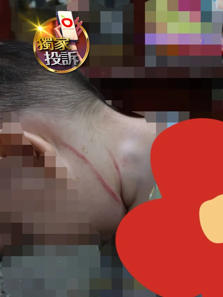 男童臉部及頸部被托育員打到出現2道明顯抓痕及瘀青，令家長不捨。民眾提供