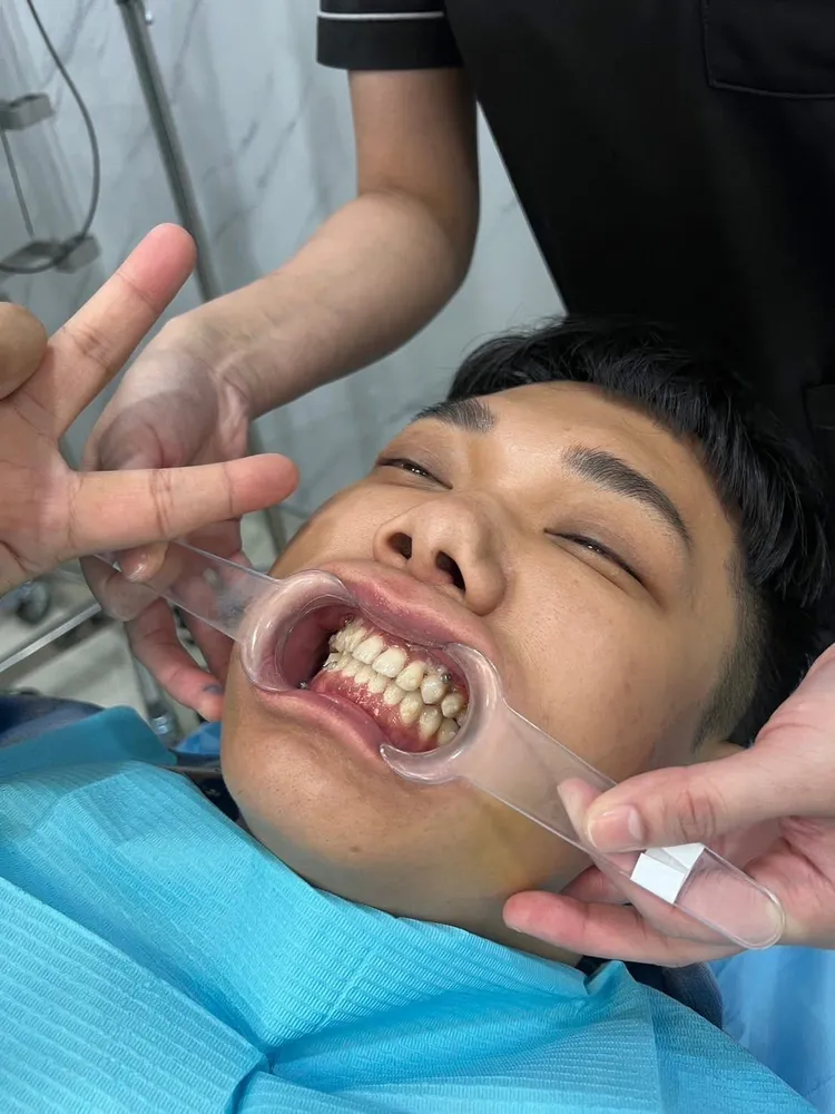 關韶文近期發現齒列又移動，決定進行二度手術。翻攝關韶文臉書