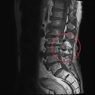 婦人發燒、下背嚴重疼痛，經檢查後確認是鏈球菌感染脊椎（紅圈處）。亞大附醫提供