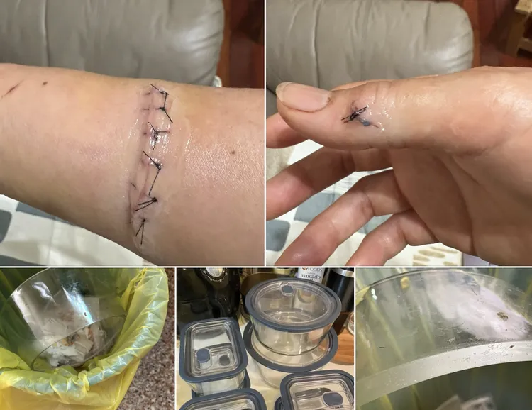 民眾貼出被保鮮碗割傷的傷口。翻攝自「全聯消費經驗老實說」臉書