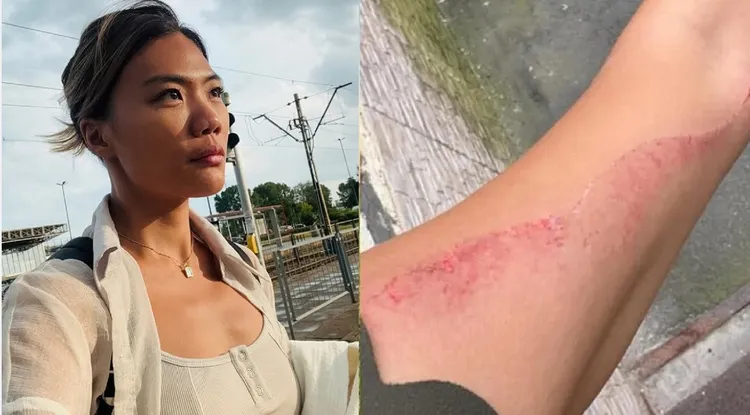 網紅小象24日出發前往烏克蘭，與飯店老闆衝突後po手臂傷痕照。翻攝小象IG