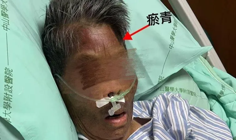 家屬以為老奶奶臉上的不明瘀青，是抗凝血藥物造成，後來才發現是看護施虐。翻攝臉書「爆料公社」