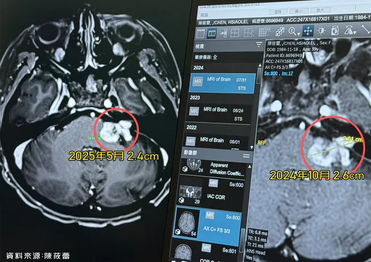 陳筱蕾2024年腦瘤2.6公分，今年5月照MRI發現腫瘤變小0.2公分了。年代提供
