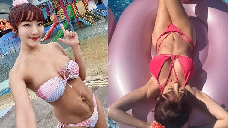 李宓懷胎3次生下5個寶寶，肚皮鬆弛滿是妊娠紋（左圖），於是去做了腹部拉皮手術（右圖）。翻攝李宓臉書