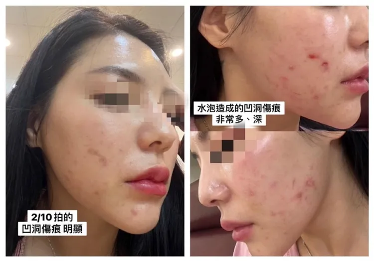 民眾誤信小蜜蜂銷售話術，施打仿冒的海芙音波後臉部嚴重灼傷（來源：網路資料）