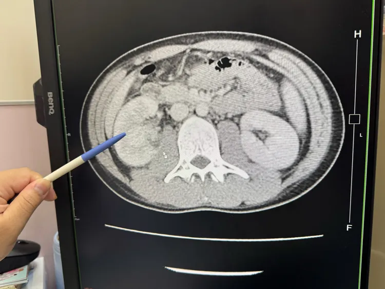 23歲男子每天喝2杯半糖手搖飲，不喝開水，結果罹患急性腎盂腎炎，一邊腎臟腫大一倍大。大甲李綜合醫院提供