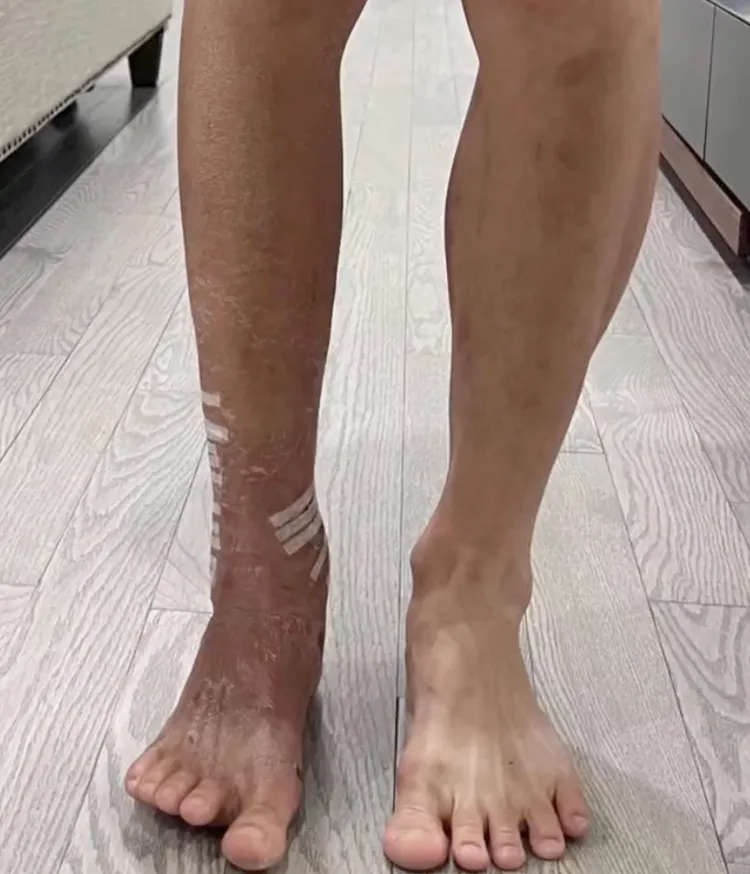 陳學冬受傷後雙腿粗細不同。翻攝陳學冬抖音