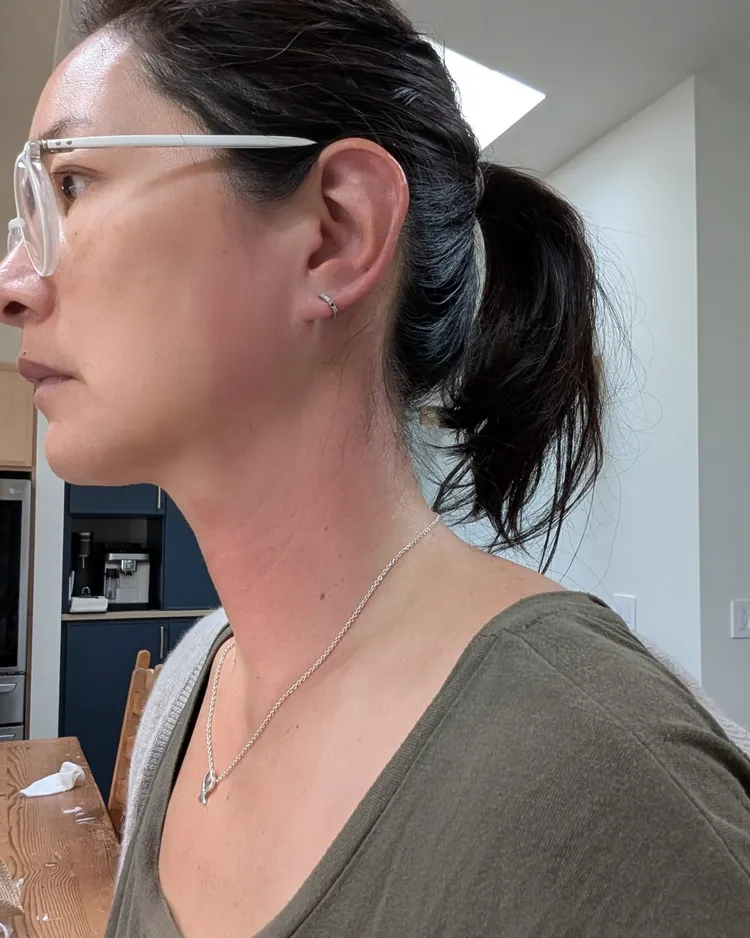 Janet從左臉頰、耳朵到脖子，都出現明顯紅腫。翻攝Janet臉書