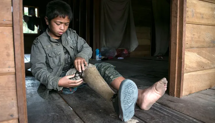 被人員殺傷地雷炸斷腿的男孩。翻攝International Committee of the Red Cross