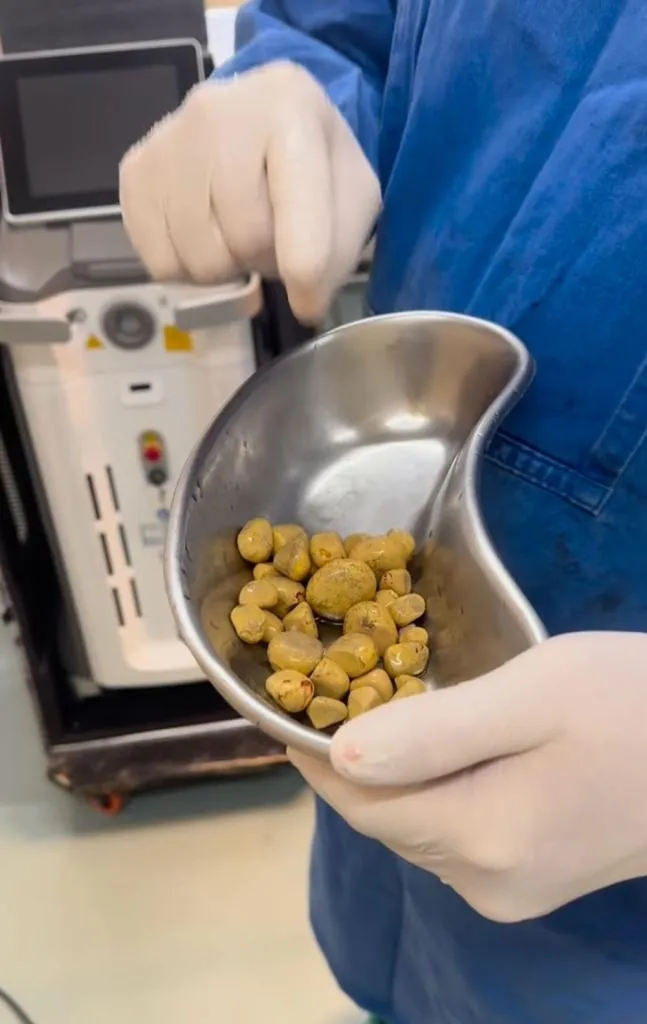 醫師取出黃色腎結石。翻攝自IG