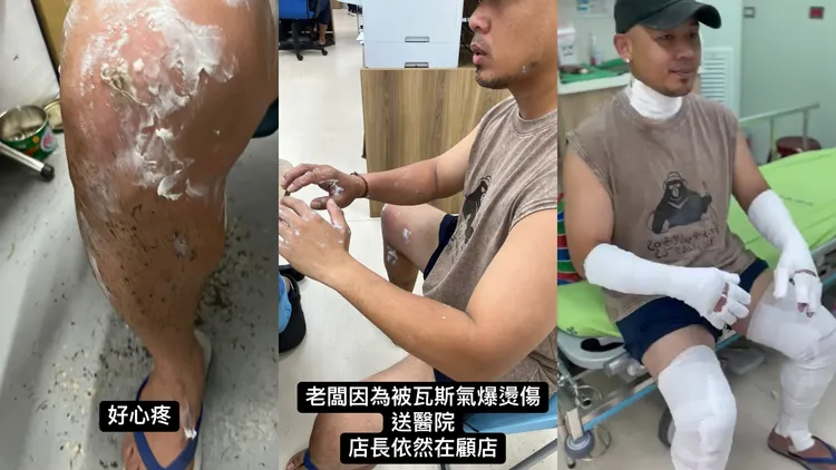 紀曉君老公遇瓦斯氣爆，全身二度燒燙傷。翻攝紀曉君IG