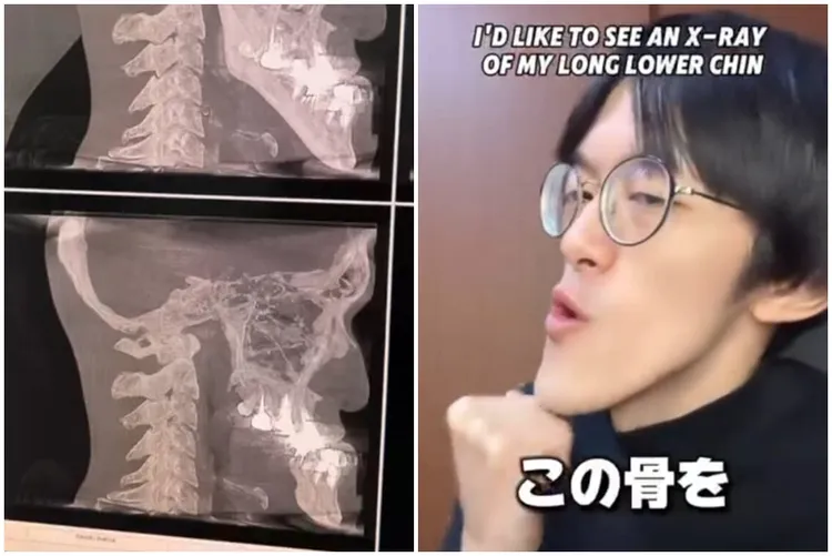 城之內拍攝X光，下顎骨形狀完整曝光。Instagram