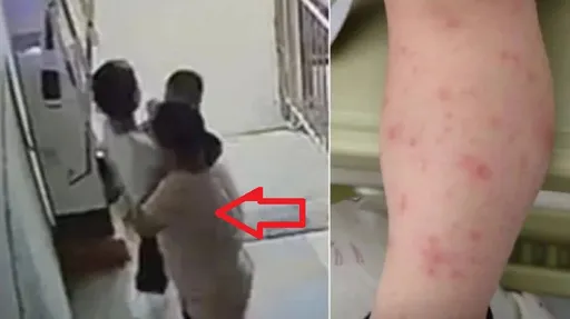 恐怖大媽「張嘴強吻」鄰居幼童!當晚就發燒長水痘 自己小孩卻痊癒了