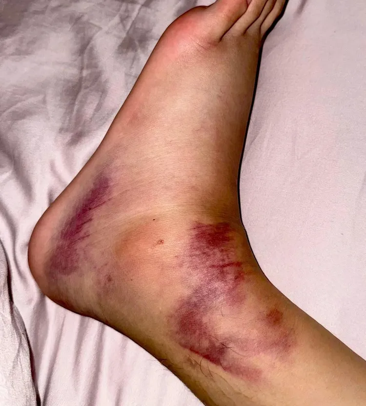 洪暐哲右腳韌帶撕裂，佈滿瘀血讓人看了觸目驚心。年代整合行銷提供