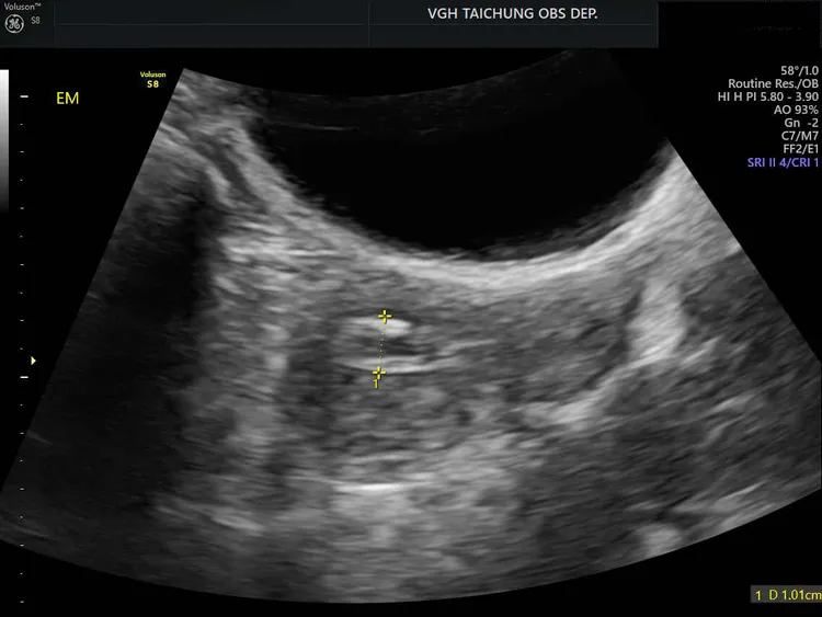 透過超音波可見患者子宮內有異常息肉。中榮提供