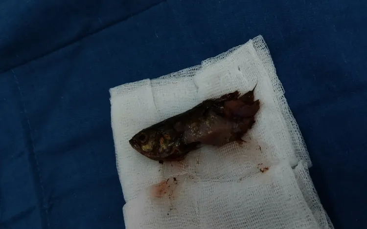 醫生開刀取出活魚。越南青年報