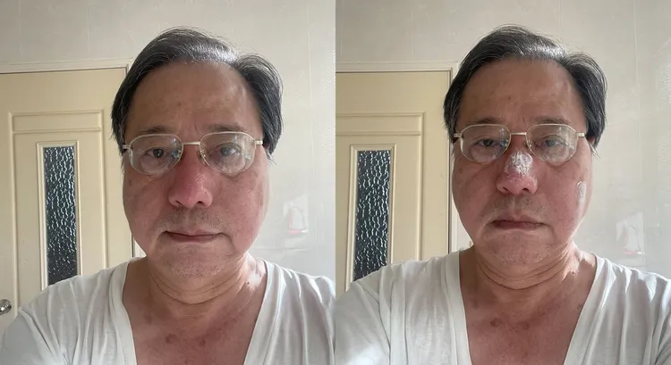 李來希自嘲鼻樑腫脹猶似豬八戒。翻攝李來希臉書