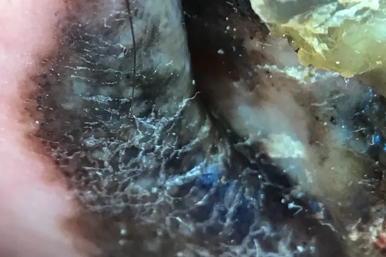 在皮膚鏡高倍顯像下，惡性黑色素瘤的黑色素顏色深淺不一，腫瘤邊緣不規則。台北慈濟醫院提供