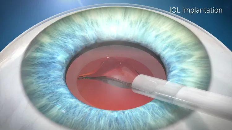 德國蔡司老花專家會針對患者眼睛狀況、個人生活需求建議適合的「老花人工水晶體」。