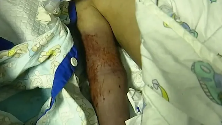 男童被救起時，手臂出現被排水孔緊吸後留下的傷痕。翻攝自《1818黃金眼》