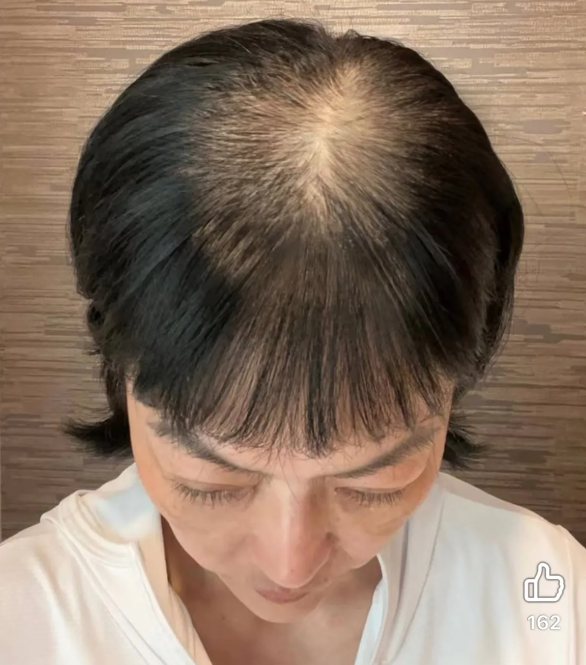 唐玲秀出化疗期间头顶秃一块照片来鼓励癌友。翻摄自唐玲脸书