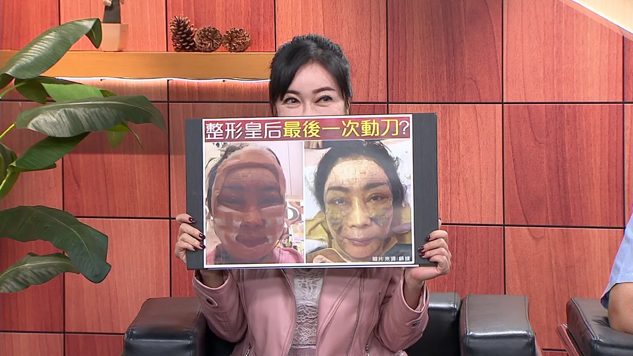 顾婕今年施作三层筋膜大拉皮手术。年代提供