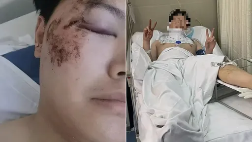 睡觉做个梦「醒来已经在空中」 下一秒他坠落3楼全身多处骨折