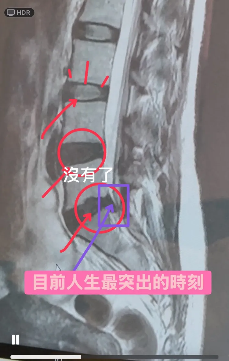 萁萁椎間盤突出一度痛到不行。翻攝萁萁的黃三寶臉書