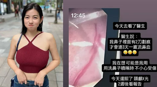 米可白连3天鼻血直流查出2刀划痕!年底就要动手术