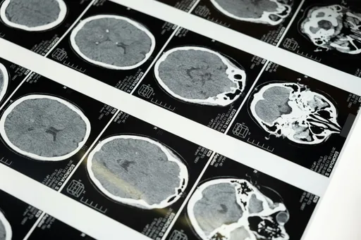 妇游日突脑出血!开脑+专机花255万 医吁:这类患者最需小心