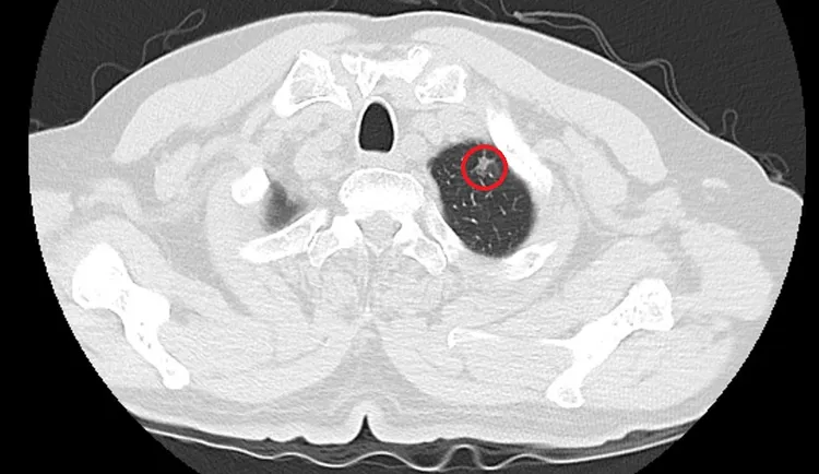 切除可疑肺病灶後，病理報告證實為肺腺癌。光田醫院提供