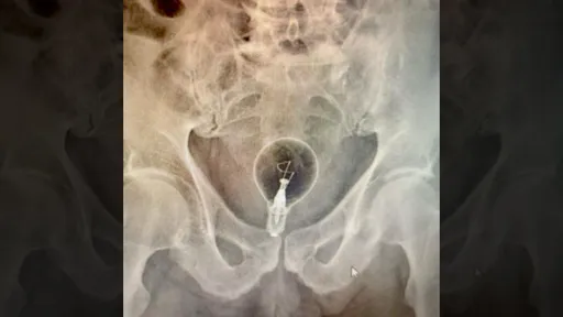 85歲翁「燈炮爆菊」卡住了 竟拿螺絲起子硬撬結果更慘