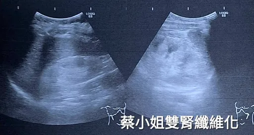 28歲輕熟女早發型糖尿病 輕忽控糖「惡化更快」恐終身洗腎