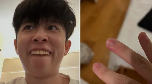 HOOK歐洲拍片手指腫出黑膿包!大驚問醫生「要馬上回台灣嗎」