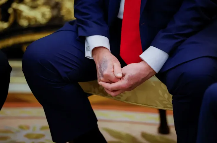 川普多次被拍到手背有瘀青。路透社資料照片