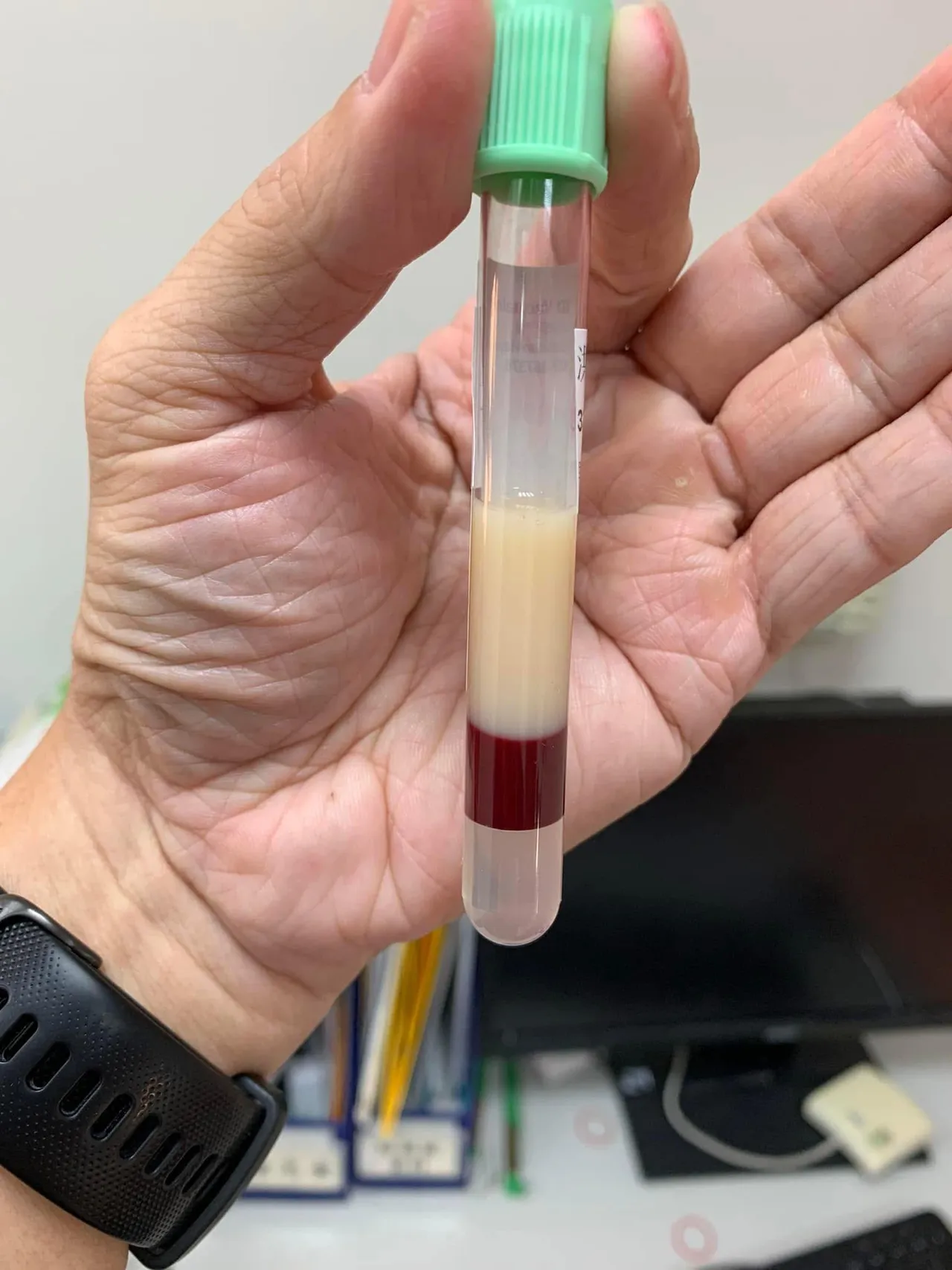高油脂病患抽出來的血,油脂量竟比血液還多。翻攝陳志金臉書