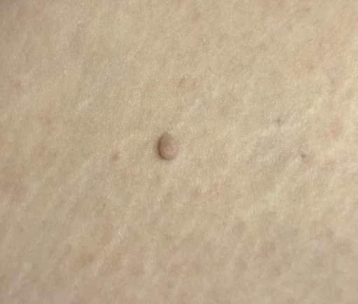 長出贅生皮別亂處理 皮膚科醫:自行掐除恐感染留疤