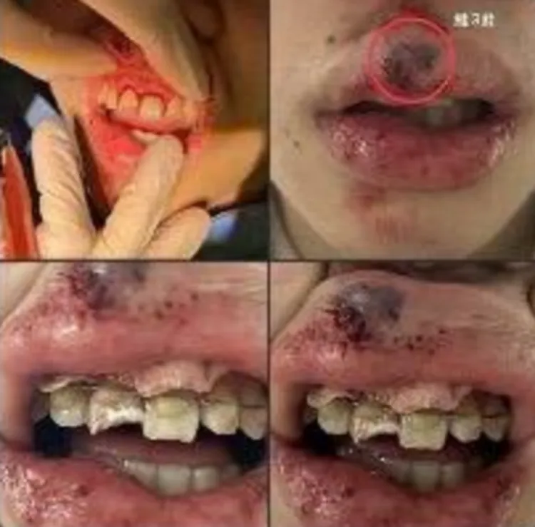 孩童騎YouBike遭鏈蓋夾鞋摔飛，牙齒斷裂、唇部撕裂，卻因未達理賠門檻無法申請補償。許淑華議員辦公室提供