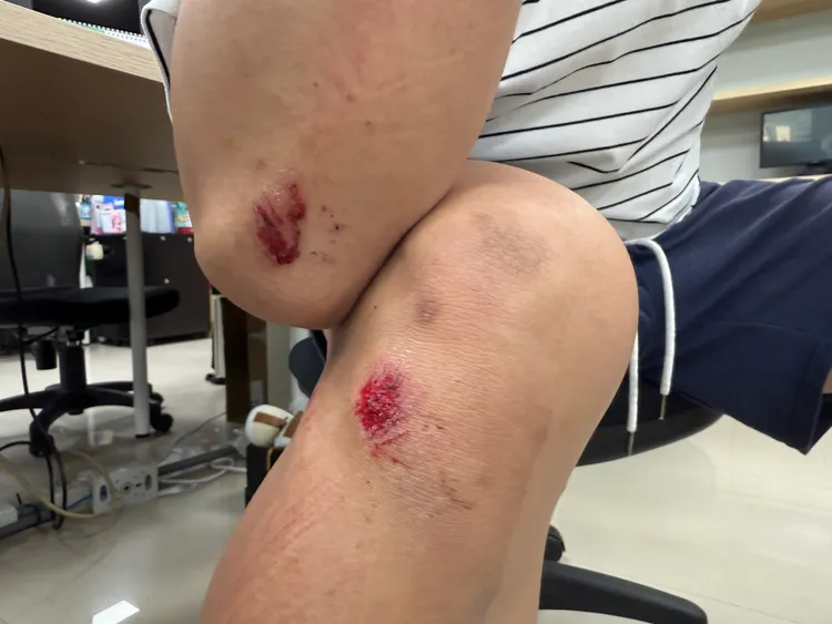 北市上班族因騎YouBike閃避機車摔傷。投訴民眾提供