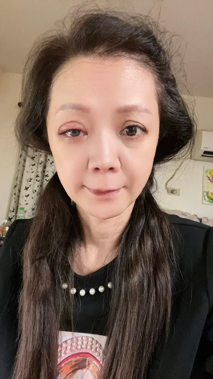 高欣欣因為點錯眼藥水掛急診。翻攝高欣欣臉書