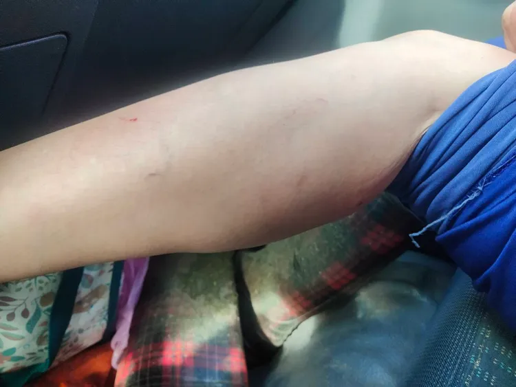 砍草工人手臂遭蜂螫3針。玉里鎮公所提供