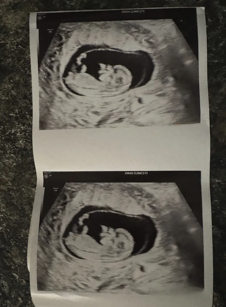 芮德曬出超音波圖。翻攝芮德IG