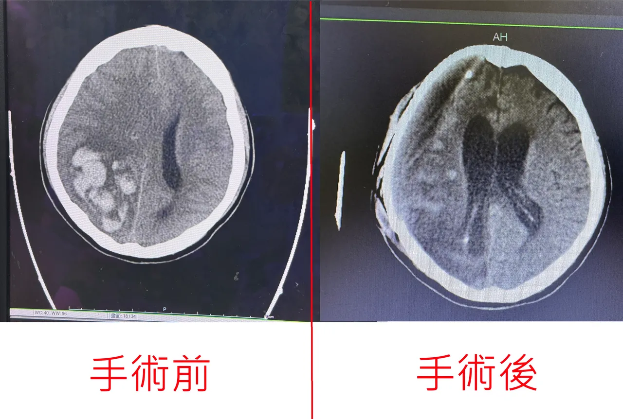 手術前大片高密度血塊,屬於腦內出血;手術後原先的大血塊已明顯移除。烏日林新醫院提供