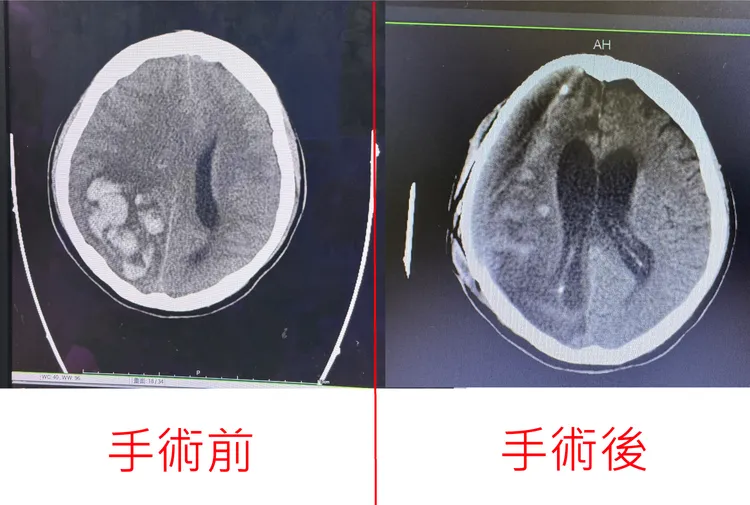 手術前大片高密度血塊，屬於腦內出血；手術後原先的大血塊已明顯移除。烏日林新醫院提供
