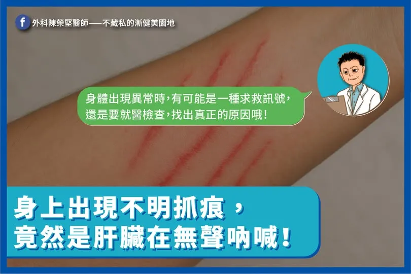 肝指数和黄疸指数高会引起皮肤搔痒而不自觉抓痒留下抓痕。图取自陈荣坚医师脸书