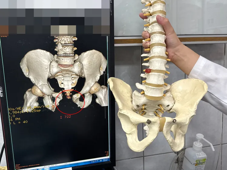 外科醫師吳坤達拿模型比對，指出患者骨盆明顯破裂。李綜合醫院提供