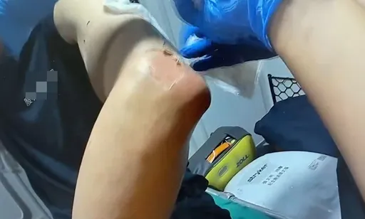 烧烤店卡式炉气爆 1员工2度烧烫伤送医