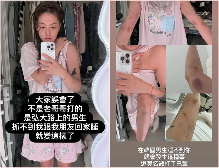 YTR劉力穎和朋友在首爾弘大夜店區遭男子毆打，她表示對方搭訕遭婉拒，竟然就毆打她們。翻攝自劉力穎IG