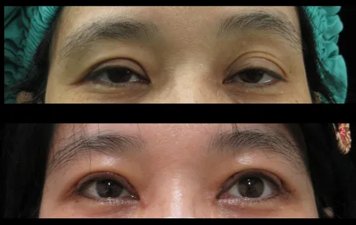 47歲女眼瞼下垂「像天天睡不飽」 提眼矯正術助她變身美魔女