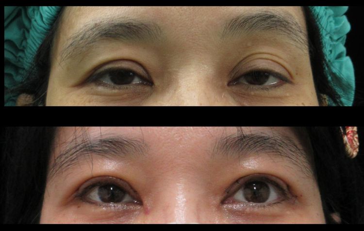 47歲女眼瞼下垂「像天天睡不飽」　提眼矯正術助她變身美魔女